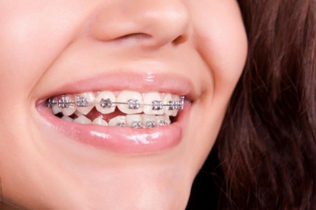 Expansion palatine orthodontique chez l'adulte