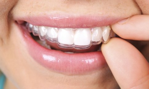 Gouttière invisalign prix