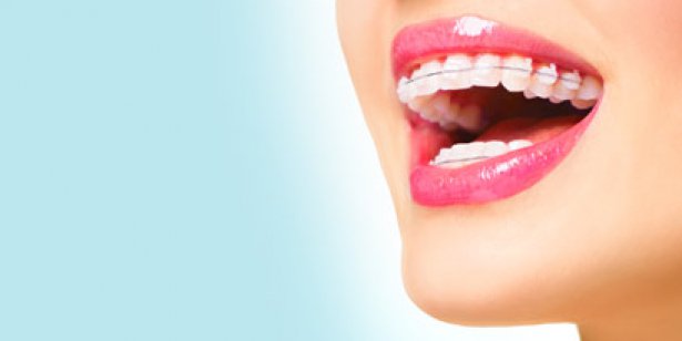 Orthodontie et Invisalign