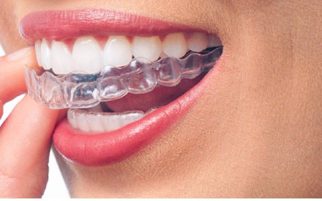 Les avantages d'Invisalign