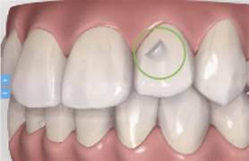 Oups! J'ai perdu mon bouton Invisalign. Est-ce grave?