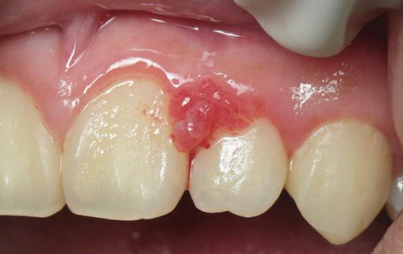 Gencives noires, gencives bleues ou gencives grises : tout s’explique