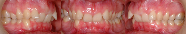 Malocclusion Classe 2 Division 2 : utiliser la croissance de l’enfant pour éviter la chirurgie plus tard