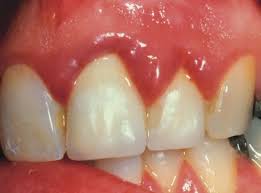 Parodontite : une maladie buccale aux nombreuses facettes