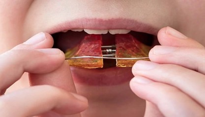 Orthodontie Phase 1 : pourquoi agir tôt peut tout changer