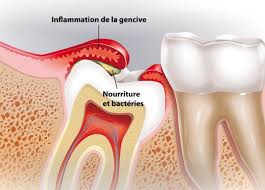 La principale raison derrière l’extraction des dents de sagesse