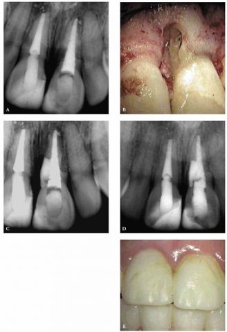 Résorption externe cervicale invasive, présentation d'un cas 