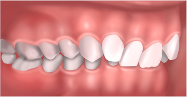 La supraclusion ou overbite: des conséquences bien visibles plus tard